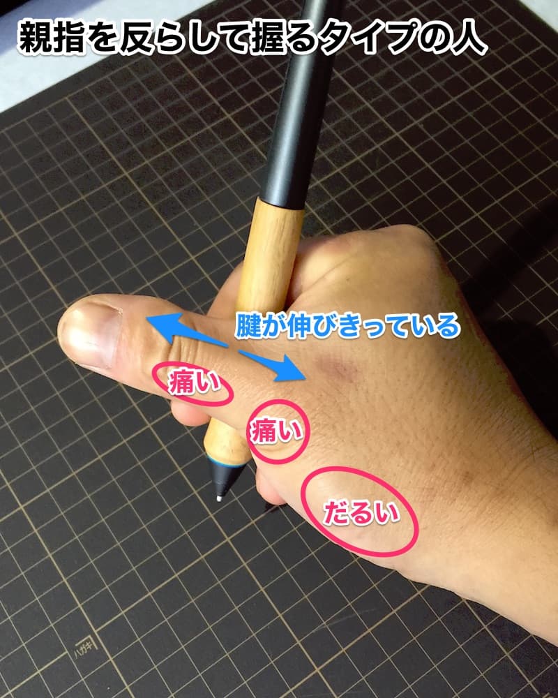親指を反らして握るタイプの握り方。痛む部位の図解